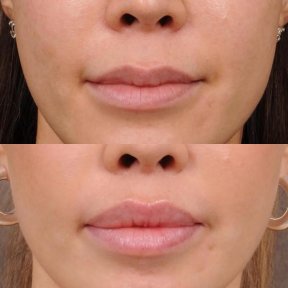 before-after photo lip-lift