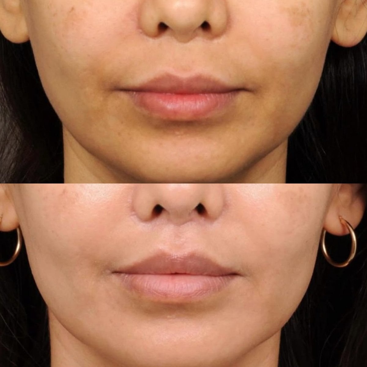 Resultados antes y después de lip lift en Dr. Alexandro Aguilera - Plastic Surgery, contorno mejorado