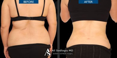 before-after photo abdominoplasty