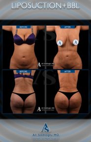before-after photo abdominoplasty