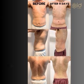 before-after photo tummy-tuck-and-liposuction