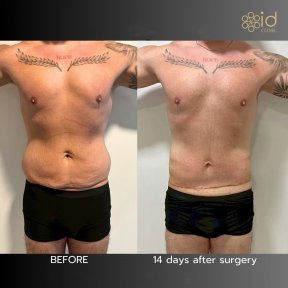 before-after photo tummy-tuck-and-liposuction