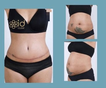 before-after photo abdominoplasty