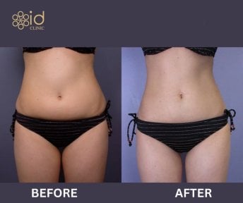 before-after photo abdominoplasty