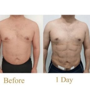 before-after photo abdominal-liposuction
