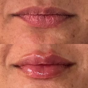 before-after photo hyaluronic-acid-fillers