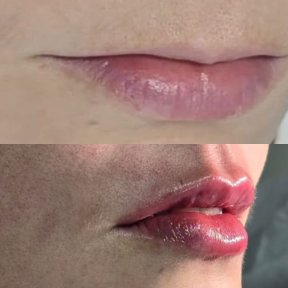 before-after photo hyaluronic-acid-fillers