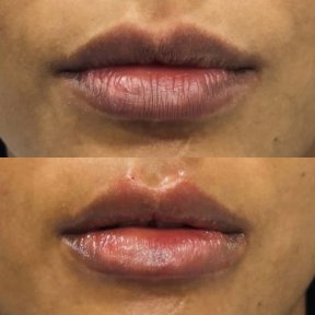 before-after photo hyaluronic-acid-fillers