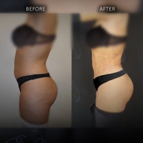 before-after photo 360-liposuction