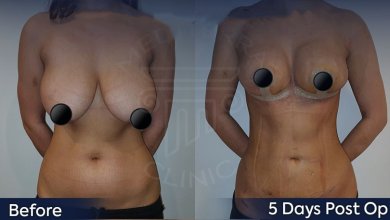 before-after photo 360-liposuction