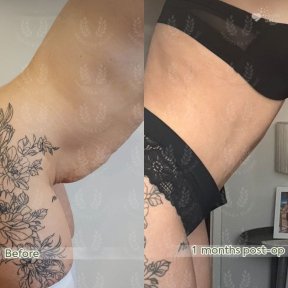 before-after photo 360-liposuction
