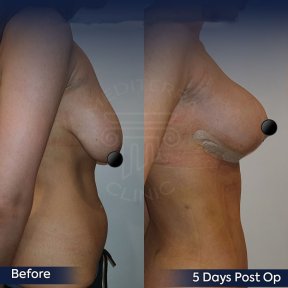 before-after photo 360-liposuction