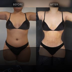 before-after photo 360-liposuction