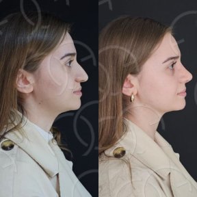 before-after photo rhinoplasty-nose-job
