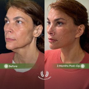 before-after photo deep-plane-facelift