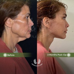 before-after photo deep-plane-facelift
