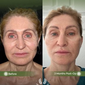 before-after photo deep-plane-facelift