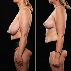 before-after photo breast-reduction