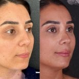 Resultados de rinoplastia antes y después en Vanity Cosmetic Surgery Center, nariz refinada