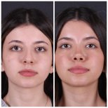 Resultado de rinoplastia antes y después en Vanity Cosmetic Surgery Center, nariz refinada