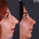 Resultados de rinoplastia antes y después en Vanity Cosmetic Surgery Center, remodelación nasal