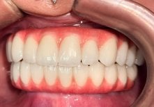 Результат імплантації All-on-4 у Dental 3 Smiles — відновлена дуга з природним виглядом