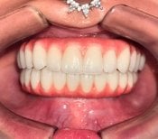 Результат імплантації All-on-4 у Dental 3 Smiles – відновлення зубного ряду
