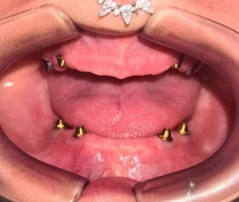 Результат встановлення імплантів All-on-4 у Dental 3 Smiles, вигляд щелеп