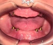 Результат встановлення імплантів All-on-4 у Dental 3 Smiles, вигляд щелеп