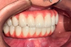 Результат імплантації All-on-4 у Dental 3 Smiles — відновлена дуга з природними зубами