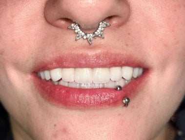 Перетворення усмішки після імплантації All-on-4 у Dental 3 Smiles, природний результат