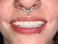 Перетворення усмішки після імплантації All-on-4 у Dental 3 Smiles, природний результат