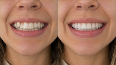 before-after photo clear-aligners