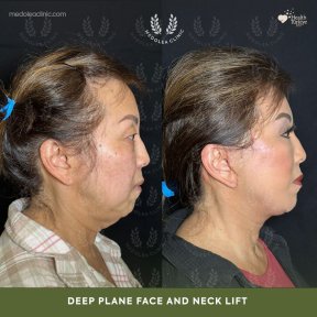 before-after photo deep-plane-facelift