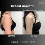 Before and after breast augmentation with Motiva Ergonomix 295cc at ID Clinic Bangkok result