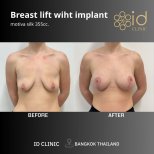 Before and after breast lift with implant at ID Clinic Bangkok, improved breast contour result
