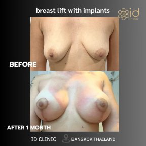 Before and after breast lift with implants at ID Clinic Bangkok, visible enhancement results