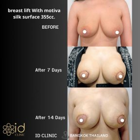Breast lift with Motiva 355cc before and after results at ID Clinic Bangkok, visible enhancement