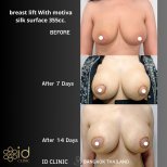 Breast lift with Motiva 355cc before and after results at ID Clinic Bangkok, visible enhancement