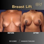 Before and after breast lift results at ID Clinic Bangkok, improved breast shape and lift
