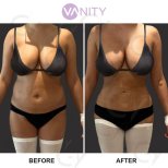Результати ліпосакції до і після у Vanity Cosmetic Surgery Center, покращений контур тіла