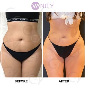 Результати ліпосакції до і після у Vanity Cosmetic Surgery Center, стрункіша талія