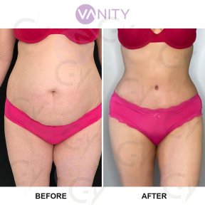 Результати ліпосакції до і після у Vanity Cosmetic Surgery Center, покращений контур тіла