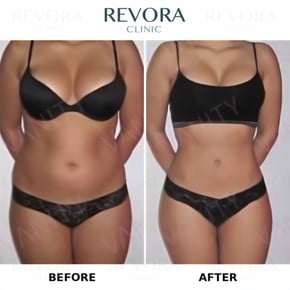 Результати ліпосакції до і після у Vanity Cosmetic Surgery Center, покращений контур тіла