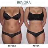 Результати ліпосакції до і після у Vanity Cosmetic Surgery Center, покращений контур тіла