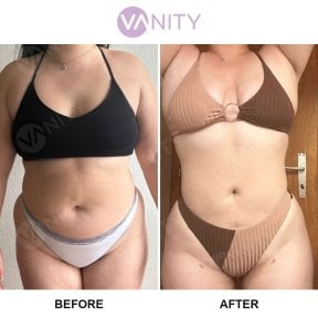 Результати ліпосакції до і після у Vanity Cosmetic Surgery Center, покращений контур тіла