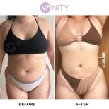 Результати ліпосакції до і після у Vanity Cosmetic Surgery Center, покращений контур тіла