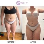 Результати ліпосакції до і після у Vanity Cosmetic Surgery Center, покращений контур тіла