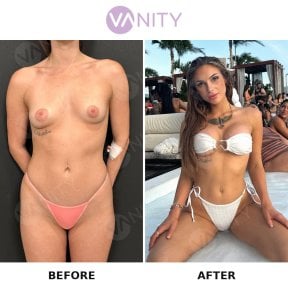 Before and after breast augmentation results at Vanity Cosmetic Surgery Center, enhanced shape