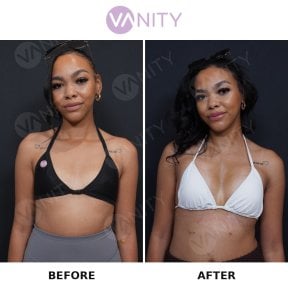 Before and after breast augmentation results at Vanity Cosmetic Surgery Center, enhanced volume
